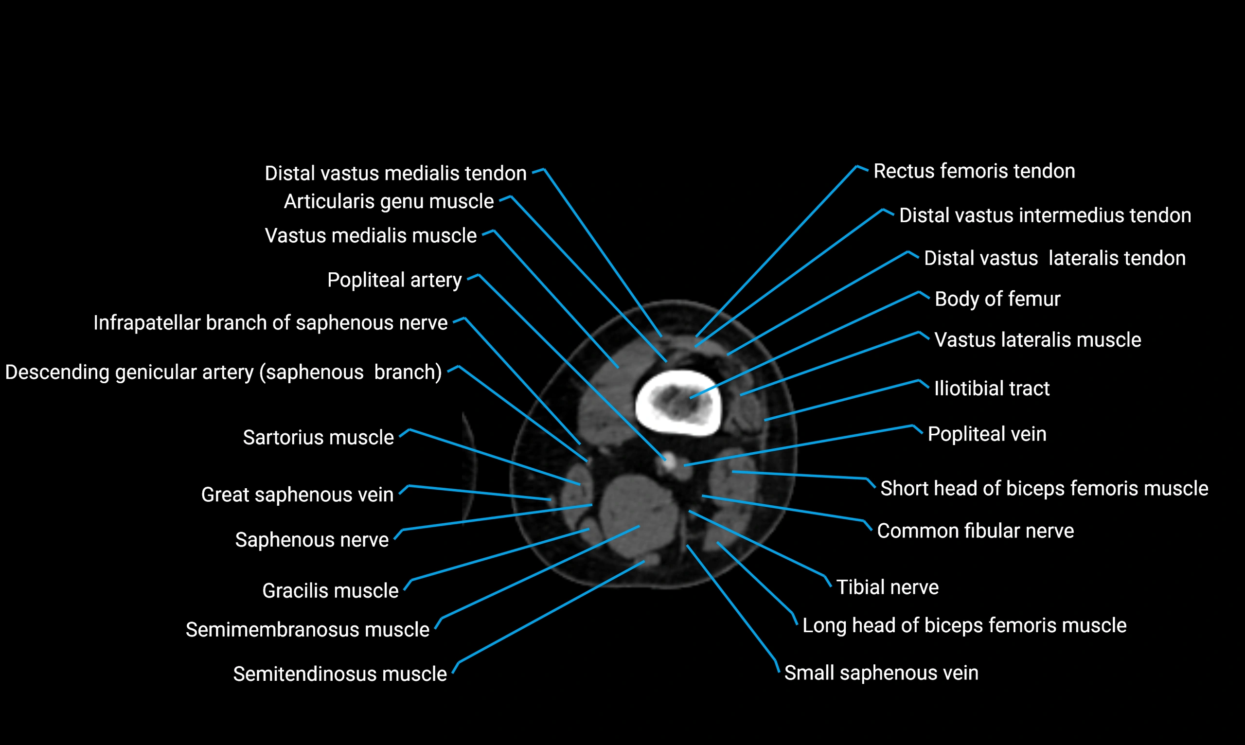 CT lower limb axial cross sectional anatomy labelled image 75 (2).webp